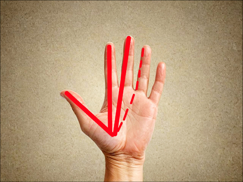 腕隧道症候群未根治 手指麻痛睡不好