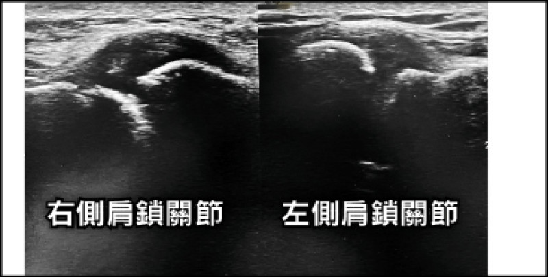 油漆工肩痛到難眠 肩鎖關節發炎惹禍