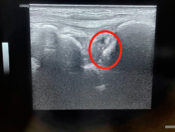 投籃手腕痛 肇因竟是摔倒手撐地