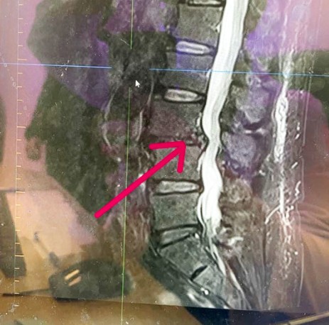 練深蹲腰就痛 椎間盤突出惹禍