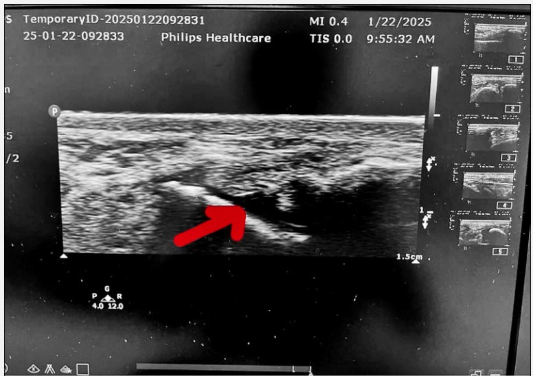 腳踝老扭傷 韌帶撕裂未癒導致
